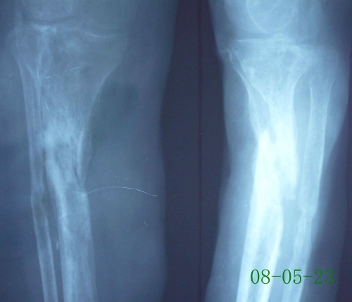 俞某-左胫骨慢性骨髓炎、骨不连-治疗后