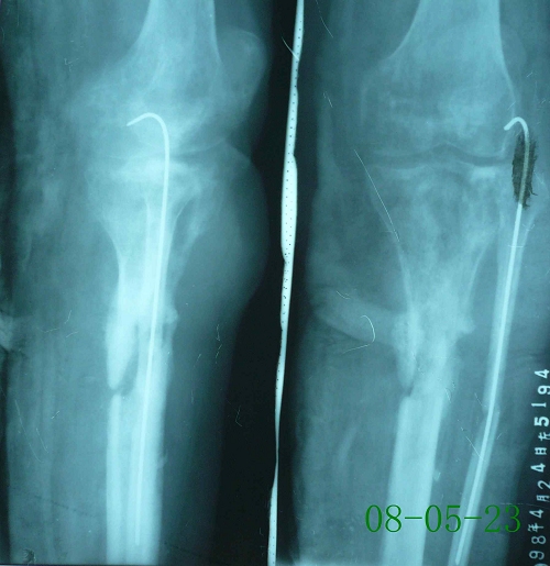 俞某-左胫骨慢性骨髓炎、骨不连-治疗前