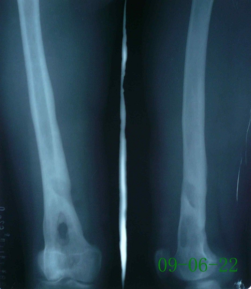 喻某-股骨下段骨髓炎、死骨形成-治疗后