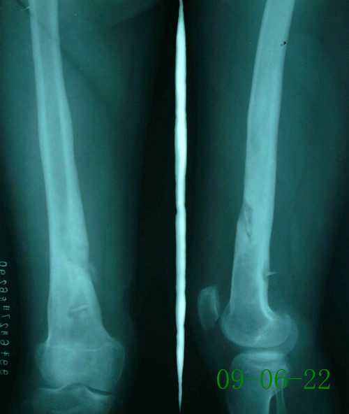 喻某-股骨下段骨髓炎、死骨形成-治疗前