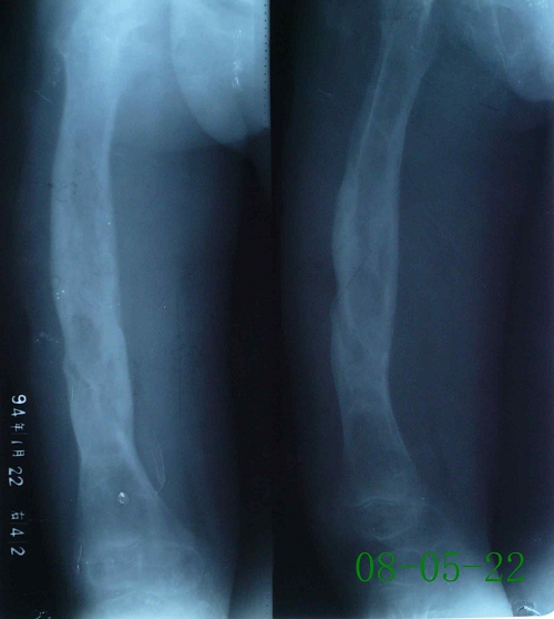 喻某-右股骨慢性骨髓炎伴病理性骨折-治疗后