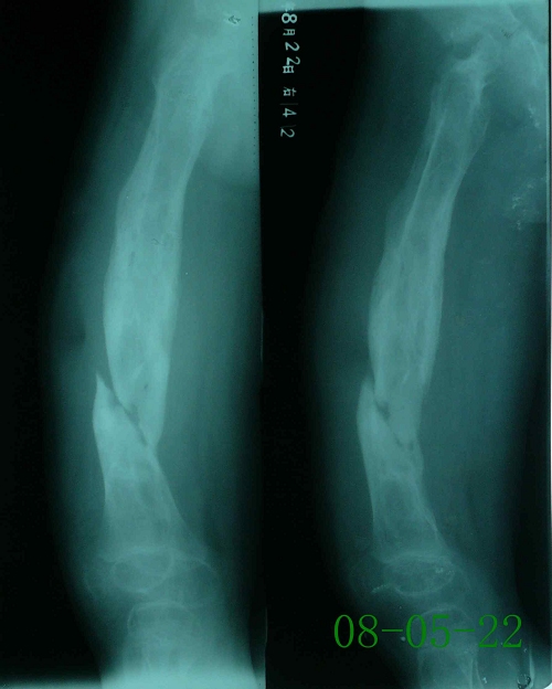 喻某-右股骨慢性骨髓炎伴病理性骨折-治疗前