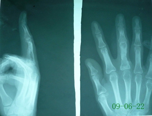 张某-右手中指指骨骨髓炎-治疗后