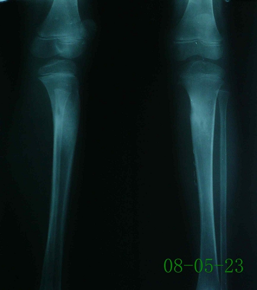 张某-左胫骨上段慢性骨髓炎伴死腔形成-治疗后
