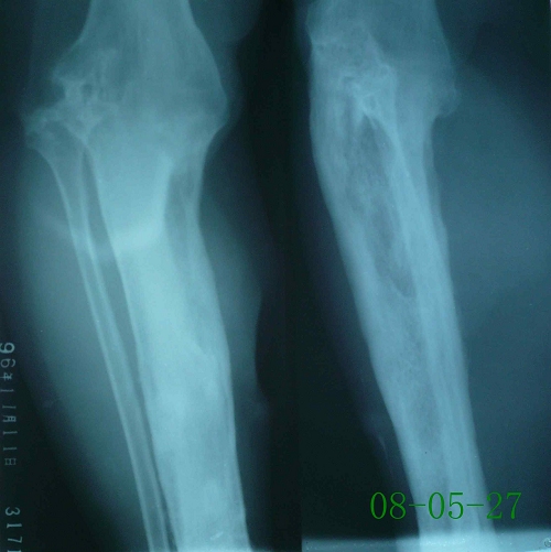 张某-右胫骨硬化性骨髓炎伴死骨形成-治疗后