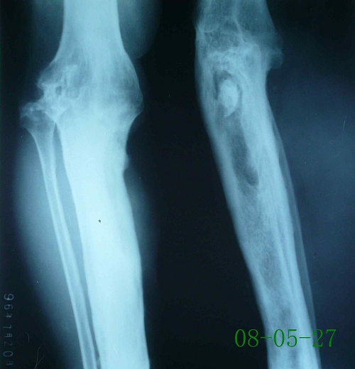 张某-右胫骨硬化性骨髓炎伴死骨形成-治疗前