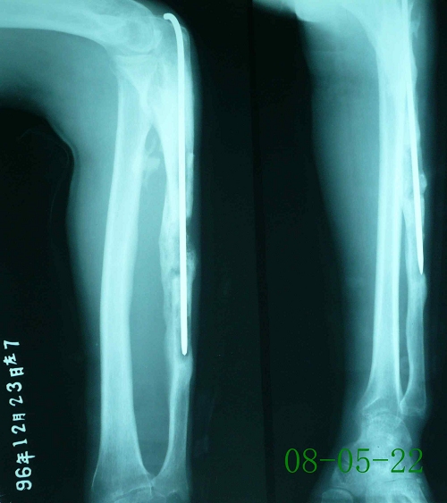 赵某-左尺骨慢性骨髓炎陈旧性骨折伴骨不连-治疗后
