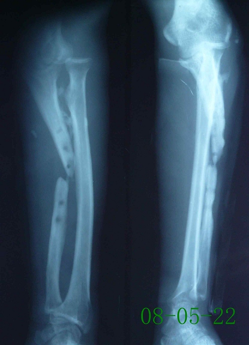 赵某-左尺骨慢性骨髓炎陈旧性骨折伴骨不连-治疗前