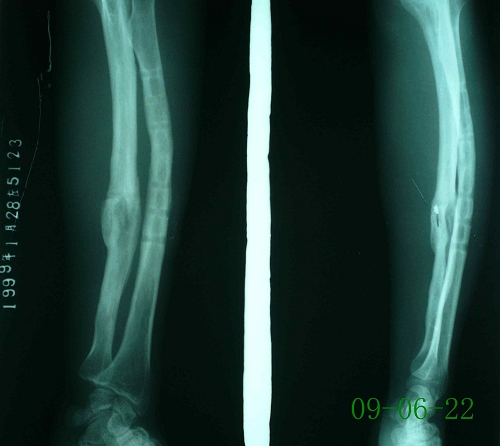郑某-尺桡骨骨折术后-治疗后