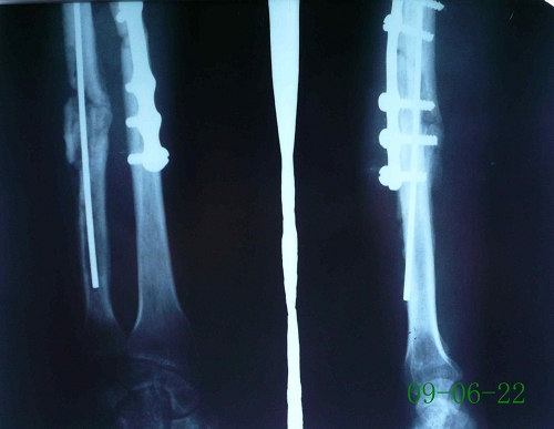 郑某-尺桡骨骨折术后-治疗前