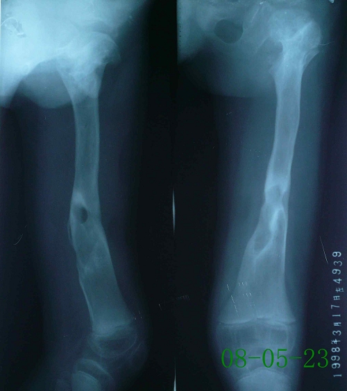 周某-左股骨化脓性骨髓炎伴死骨形成-治疗后