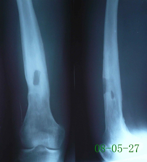 周某-右股骨慢性硬化性骨髓炎伴死骨死腔形成-治疗后