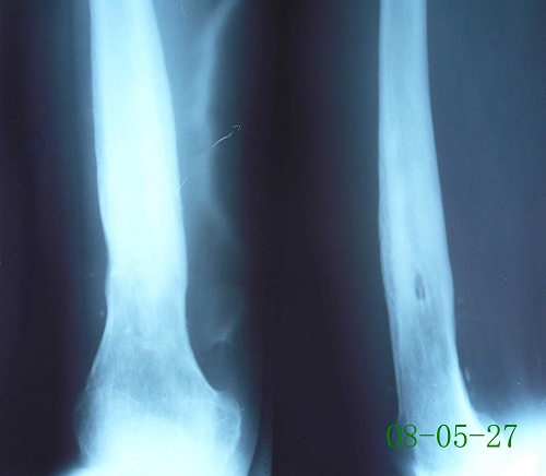周某-右股骨慢性硬化性骨髓炎伴死骨死腔形成-治疗前