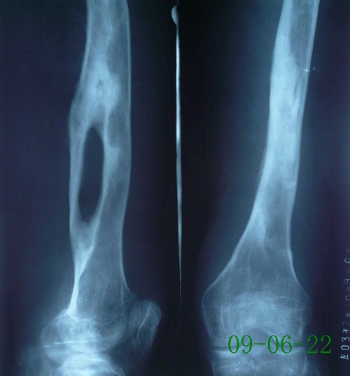 周某-股骨骨髓炎伴死骨形成-治疗后