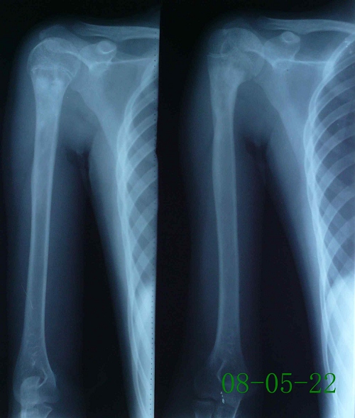 周某-右肱骨慢性骨髓炎伴死骨形成-治疗后（死骨完全吸收）