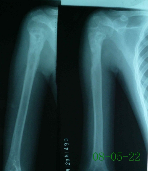 周某-右肱骨慢性骨髓炎伴死骨形成-治疗中（死骨不完全吸收）