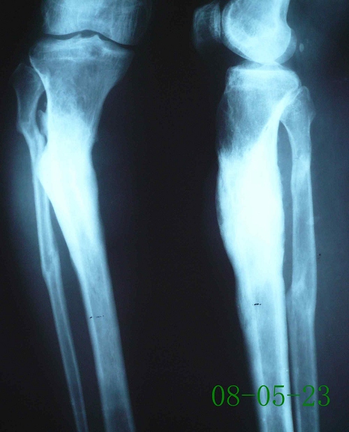 周某-右胫骨慢性骨髓炎伴陈旧性骨折、骨不连-治疗后