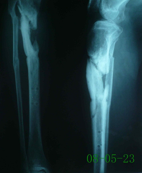 周某-右胫骨慢性骨髓炎伴陈旧性骨折、骨不连-治疗前