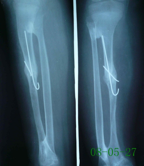 朱某-右胫骨骨髓炎、陈旧性骨折、骨不连-治疗后