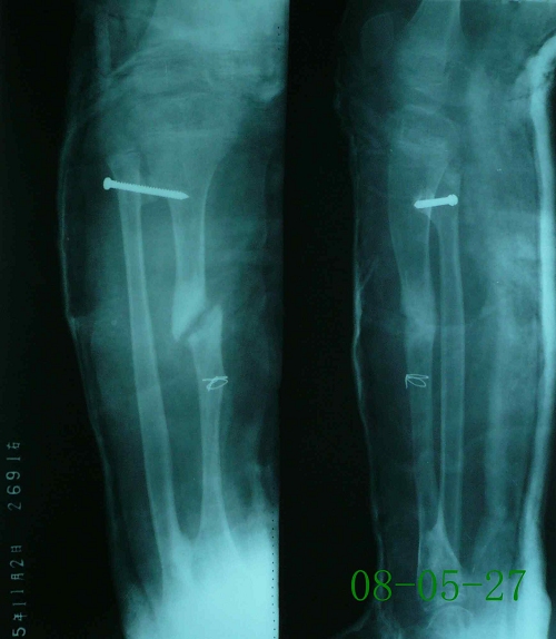 朱某-右胫骨骨髓炎、陈旧性骨折、骨不连-治疗前