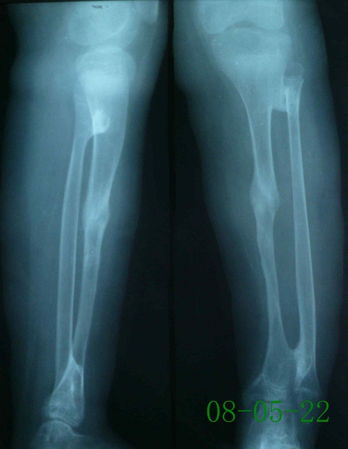 朱某-左胫骨慢性骨髓炎伴骨不连-治疗后
