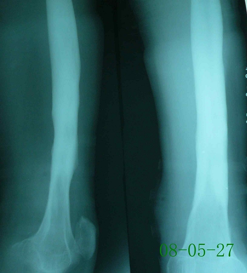 朱某-左股骨慢性化脓性骨髓炎-治疗前