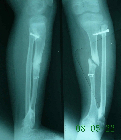 朱某-左胫骨慢性骨髓伴骨不连-治疗前