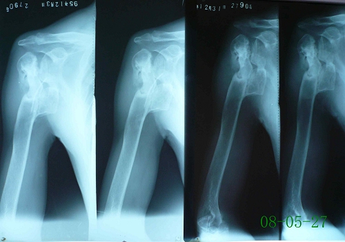 朱某-右肱骨上段骨髓炎、粉碎性骨折-治疗前后对比